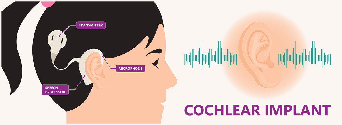 The hearing over. Cochlear implantation. Cochlear implantation book. Cochlear implantation Design. Cochlear Nucleus 6 почему нельзя самому настраивать.